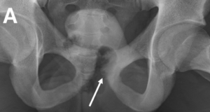 Pubic apophysitis – an important cause of groin pain in young athletes